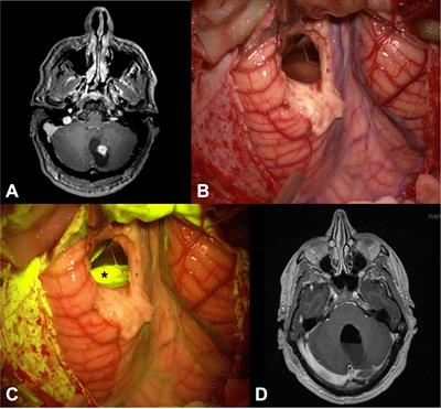 Fluorescein-guided surgery for the resection of pilocytic astrocytomas: A multicentric retrospective study